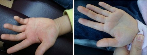 Hand palm Eczema